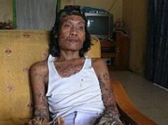 Tragedi Manusia Pohon: Kisah Dede Koswara dan Penyakit Langka yang Mengubah Hidupnya