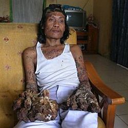 Tragedi Manusia Pohon: Kisah Dede Koswara dan Penyakit Langka yang Mengubah Hidupnya