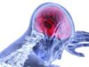 Terapi “Brain Freeze” Uji Coba Lindungi Otak Pasca-Stroke