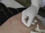 Akupuntur Berujung Petaka, 10 Jarum Patah Tertinggal di Kaki Wanita